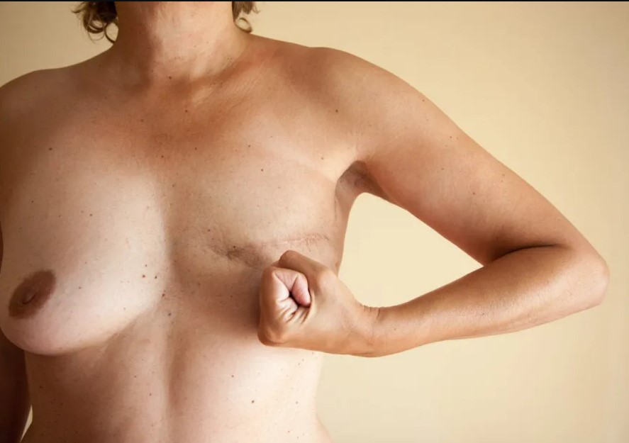 Reconstruction mammaire après un cancer : les femmes seraient mal informées
